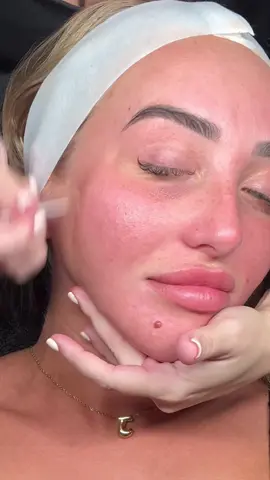Black head suction 😍 #blackhead #skincare #oil #oilyskin #facial 