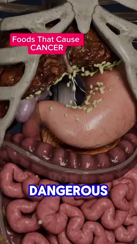 Dangerous foods that may cause cancer.. #FoodTok #FoodLover #cancer 