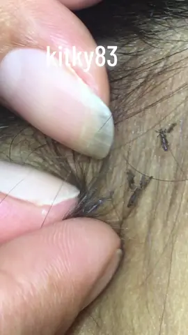 remove lice#omg😱😱❤️❤️😍 #lice #liceremoval😰😰 