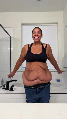 4️⃣ more days till excess skin removal surgery 🫶🏼🥹 #weightlosssurgery #wls #weightloss #extremeweightloss #motivation         