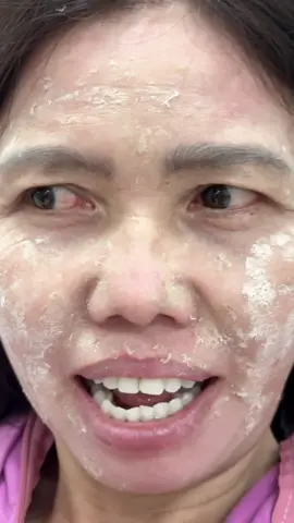 Còn da chết là còn bong nha chị em #chamsocda #spa #peeldatainha #nám #tàn_nhang 