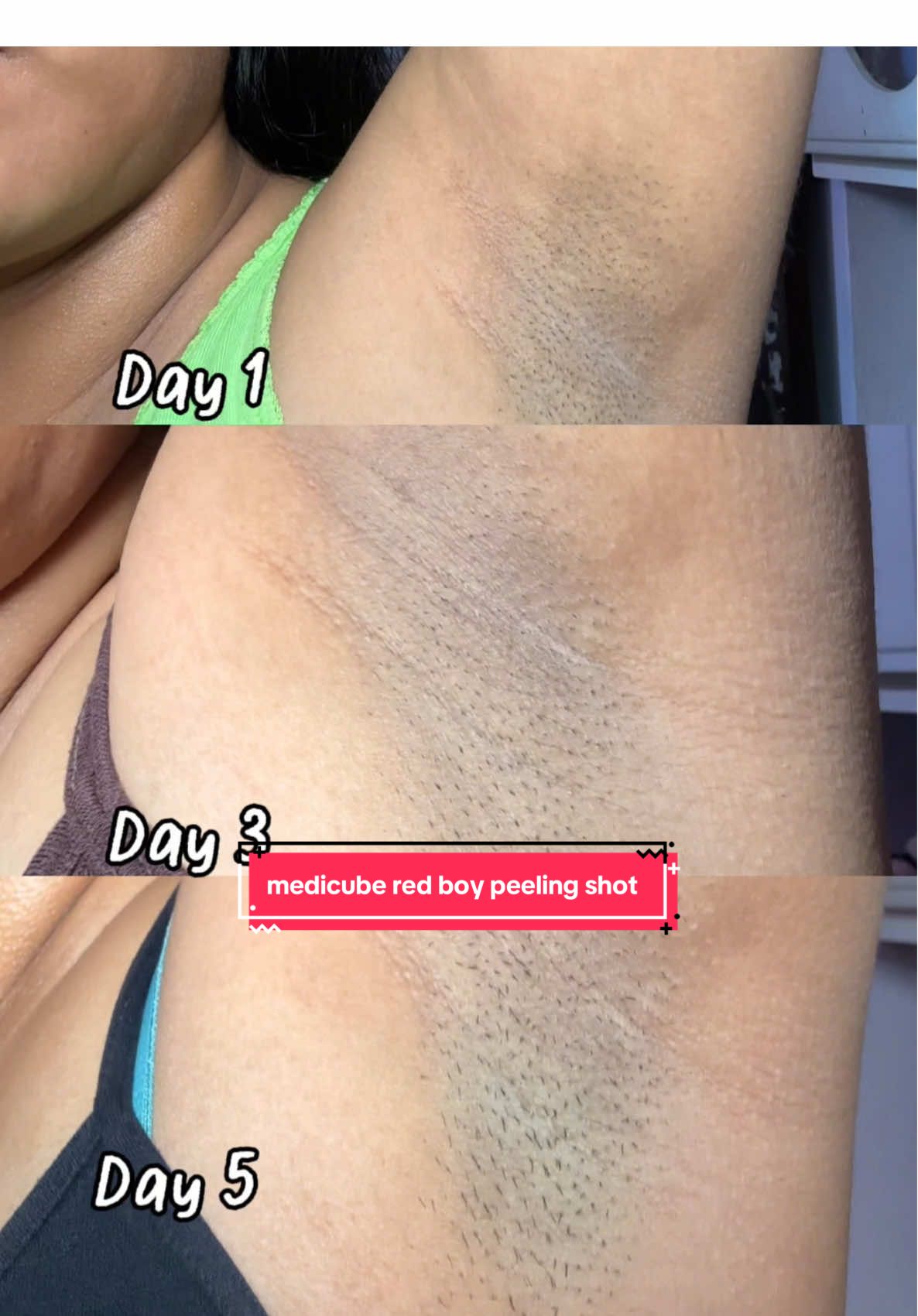 Getting my skin summer-ready with medicube body peeling shot ~ @medicube global @medicube US Store  #medicube #redbodypeelingshot #bodycare #bodypeeling #exfoliate  medicubeskincare chicken skin underarmcare ulta