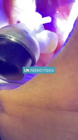 Perno fibra de vidrio🦷💎 #pernofibradevidrio #dienteroto #muelapicada #endodoncia #lapazdent 