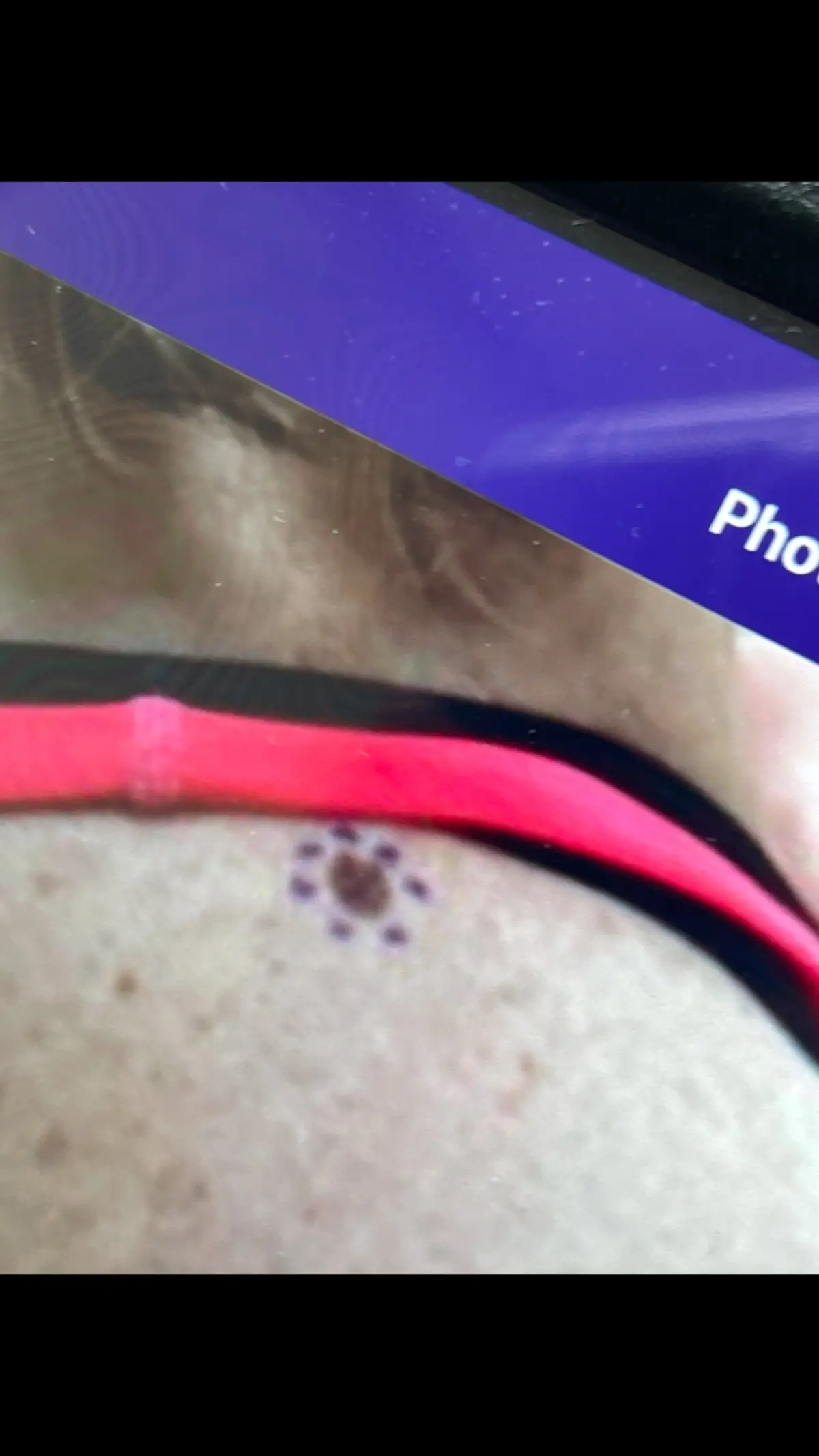 This is your reminder to go to the dermatologist and have your moles looked at. The one on my shoulder was melanoma. I was a lifeguard for years and didn’t use sunscreen. Definitely paying for it now. #dermatologist #skincancer #40