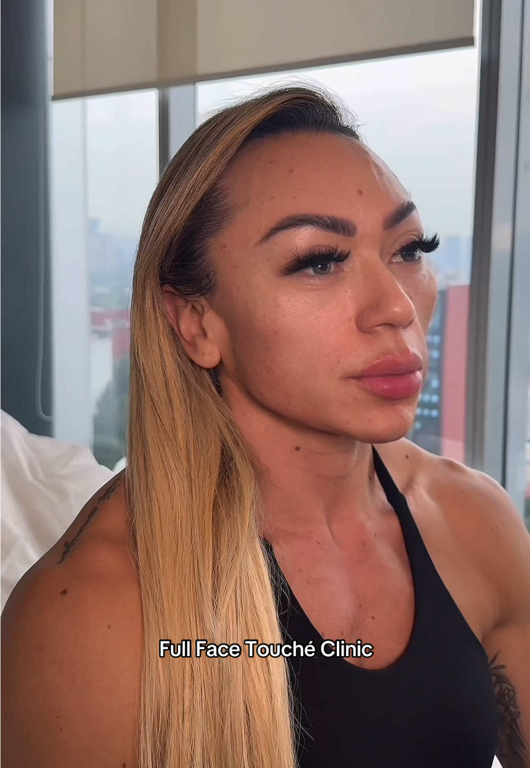 Why do athletes need fillers? Due to low body fat and intense training, the face often loses volume and looks exhausted. Fillers help restore natural contours and maintain a healthy, fresh appearance.