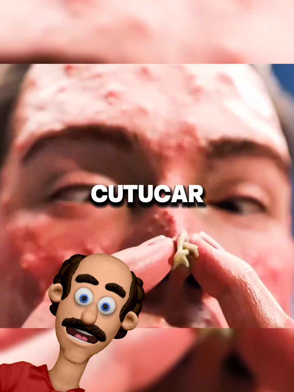 #espinhas #cravoseespinhas #fyp #viraltiktok 
