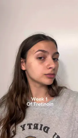 it gets better 🤧                              #acne#tretinoin#acnetreatment#skincaretiktok #acneproneskin 