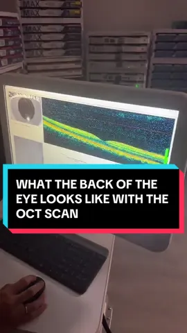 Dr. Antonyan showcases our iFusion OCT, where we can see all 10 layers of the retina at the back of the eye. This technology helps us detect early signs of glaucoma, diabetic retinopathy, macular degeneration, retinal detachments, and hypertensive damage. Even with 20/20 vision, these scans reveal changes you can’t see or feel until it’s too late. Book your appointment at Vivid Visions Optometry, Inc. in Valencia, California. We also offer virtual consultations to help you connect with a doctor in your area: www.vividvisionsoptometry.com/appointments #OCT #EyeHealth #Glaucoma #MacularDegeneration #DiabeticRetinopathy  