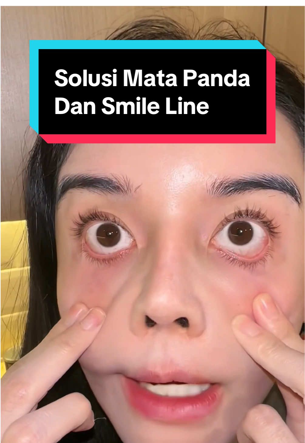 Makanya beberapa terapi mata panda ada yang pake laser mengecilkan pembuluh darah dan makanya dikompres dingin juga berkurang mata panda di beberapa orang. Di beberapa kasus mata panda terjadi karena lemak kurang (sunken eyes), celong. Kalo itu beda terapi lagi. Smile line bisa pake caffeine dan retinal jg. Kaine cream ini buat 1 muka. Boleh oot #matapanda #darkunderye #antiaging #wrinkle #skincare 