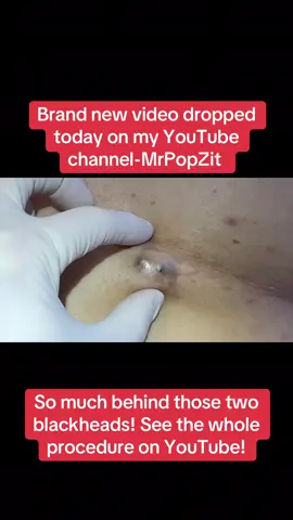 Two giant Blackheads with 10 years of keratin packed in behind them! See it all come out at MrPopZit once YouTube! So much stuffing! #blackhead #dermatology #skincare #mrpopzit #mpzdermatology