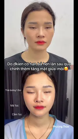 Chờ 1 ngày k xa khách quay lại với e😘😘#filer #bottox #gọnham #fullface #xuhuong 