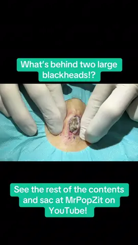 Pocket of Keratin expressed on the sternum. See the entire removal at MrPopZit on YouTube! #dermatology #mrpopzit #mpzdermatology #blackhead #cyst 