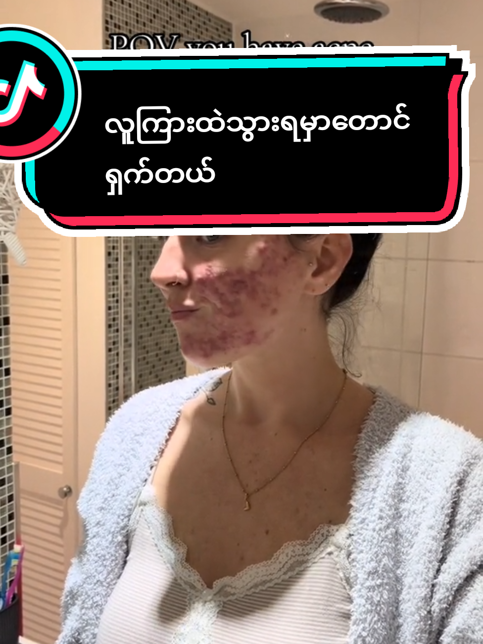#mimibooဝက်ခြံပျောက်မျက်နှာသစ် #foryou #၃ရက်အတွင်းဝက်ခြံပျောက်ဆပ်ပြာ #mimibooမျက်နှာသစ် 
