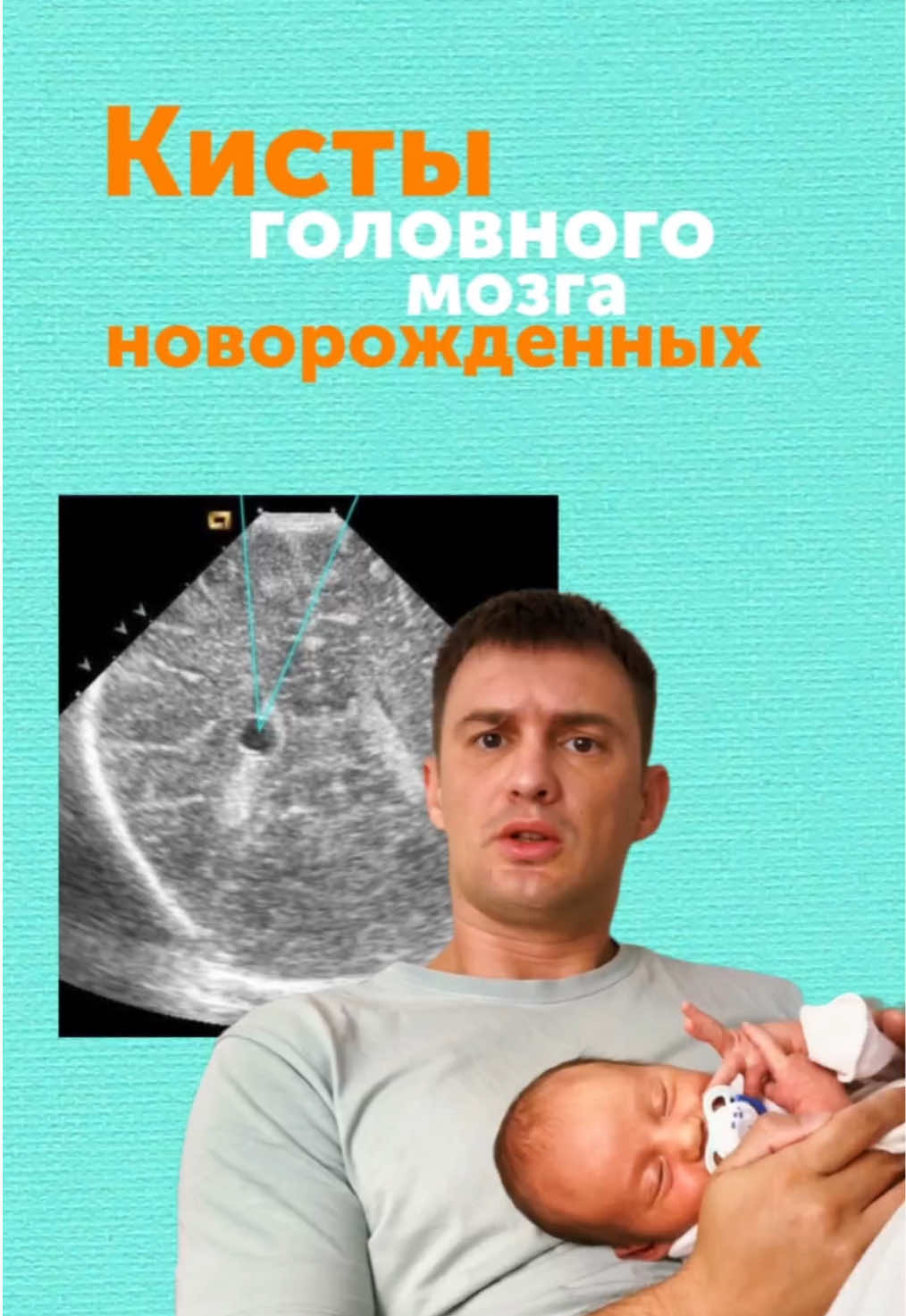 Кисты головного мозга новорожденных #кистыноворожденных 