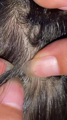 Lice#omg #lice #liceremoval 