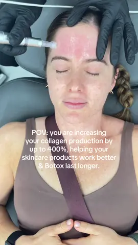 Aim for 2 sessions a year especially in your 30s #preventativeskincare #microneedling #miamiskincare 
