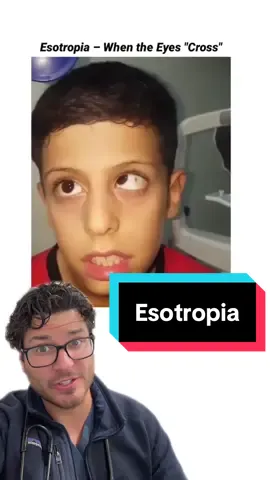 👀 Alternating esotropia is a type of strabismus where the eyes take turns crossing inward, instead of one eye being consistently affected. Because the brain alternates which eye it uses for fixation, these patients usually don’t develop amblyopia (“lazy eye”). 🔎 Causes: It can be related to genetics, abnormalities in eye muscle control, uncorrected refractive errors (like farsightedness), or issues with the nerves controlling the eye muscles. 💡 Treatment: Options may include glasses (especially if farsightedness is present), vision therapy, or surgery to realign the eye muscles when needed. Early evaluation by an eye specialist is important to preserve binocular vision and depth perception. #EyeHealth #StrabismusAwareness #PediatricOphthalmology #VisionCare #Esotropia 