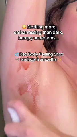 Medicube No More Bumps Set for smooth underarms, KP, and strawberry skin ✨🛒 #medicubenomorebumps #medicube #strawberryskin #darkunderarms #kp @medicube US Store @medicube global 