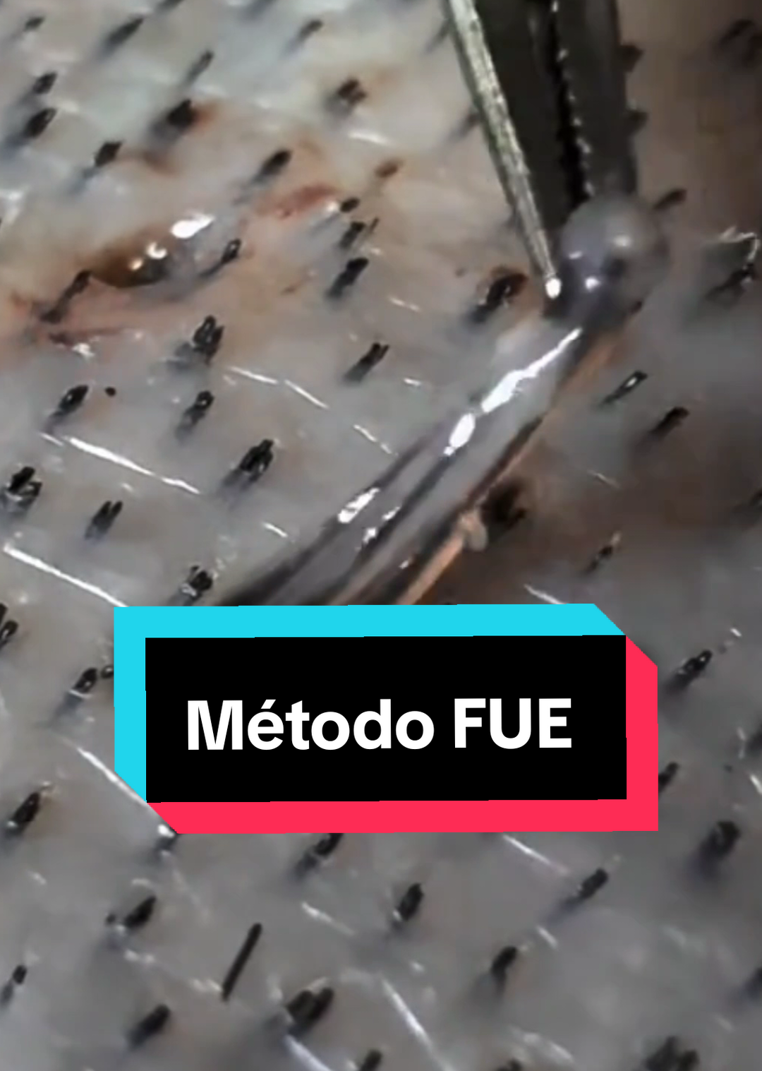 Por que escolhemos o FUE? ✨ Sem cortes grandes ✨ Sem cicatriz visível ✨ Recuperação rápida ✨ Resultado natural No FUE, os fios são retirados um a um e implantados nas áreas calvas com precisão. 👉 Técnica moderna, segura e eficaz para restaurar o cabelo. #transplantecapilar #angola🇦🇴 #angolatiktok🇦🇴❤️ #luandaangola😍🇦🇴 #angola 