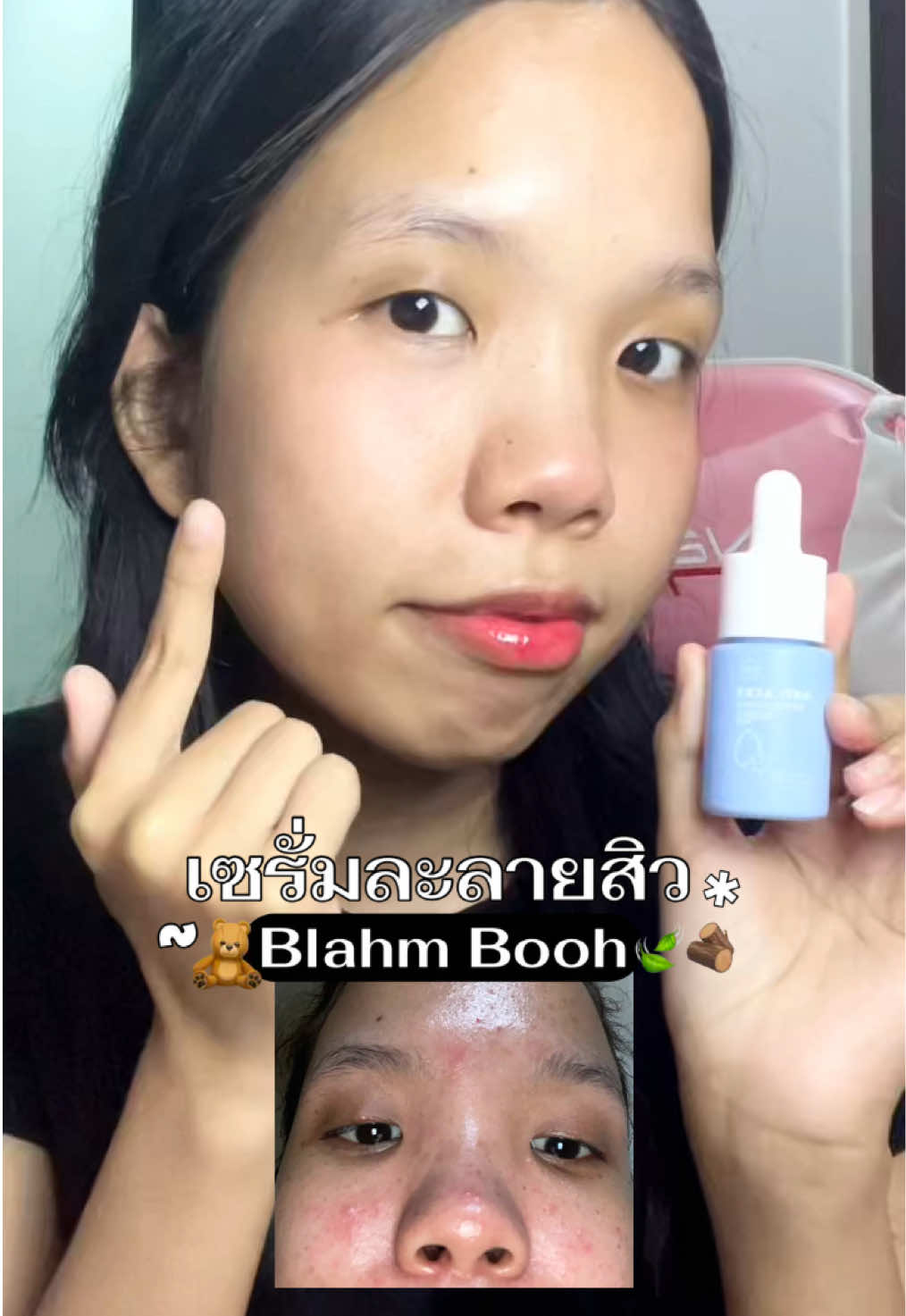 #เซรั่มละลายสิว #blahmbooh #blahmboohthailand #capcut #เซรั่มละลายสิวอุดตันblahmbooh 
