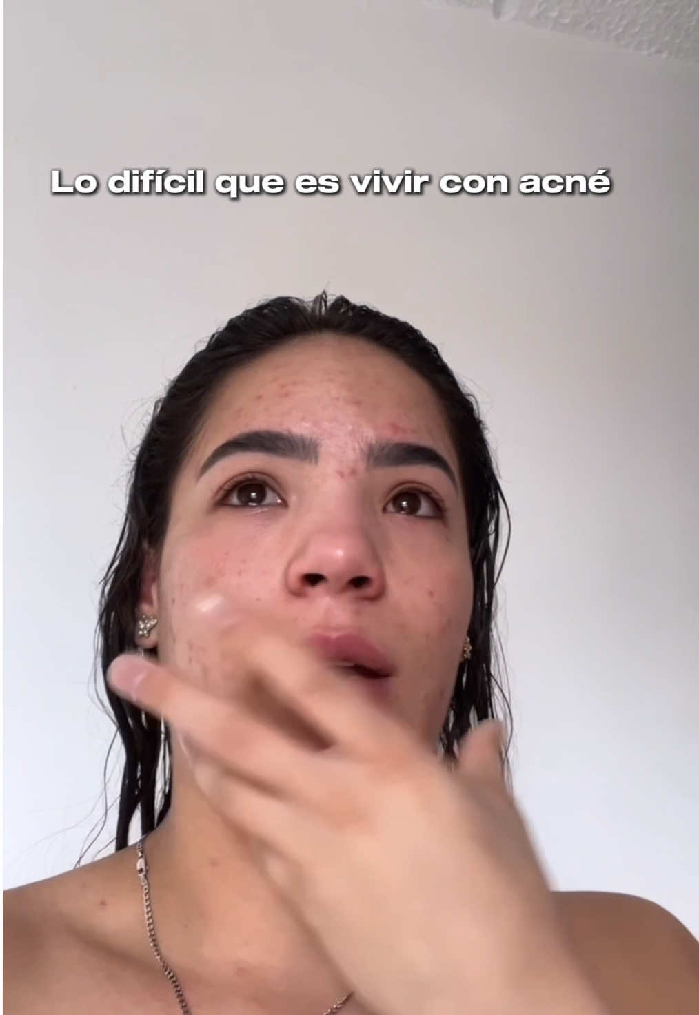 Lo difícil que es vivir con acné y tener que seguir la vida normal como si no te afectara, cuando en realidad es en lo único que piensas y lastimosamente también están los otros para recordártelo. #acne 