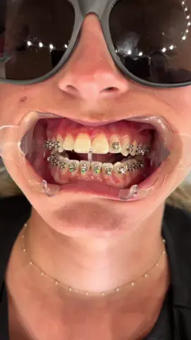 Braces on today for Payton ✨ #Orthodontics #Braces #LincolntonNC #Ormco #DamonBraces #UltimaBrackets #NewSmile 