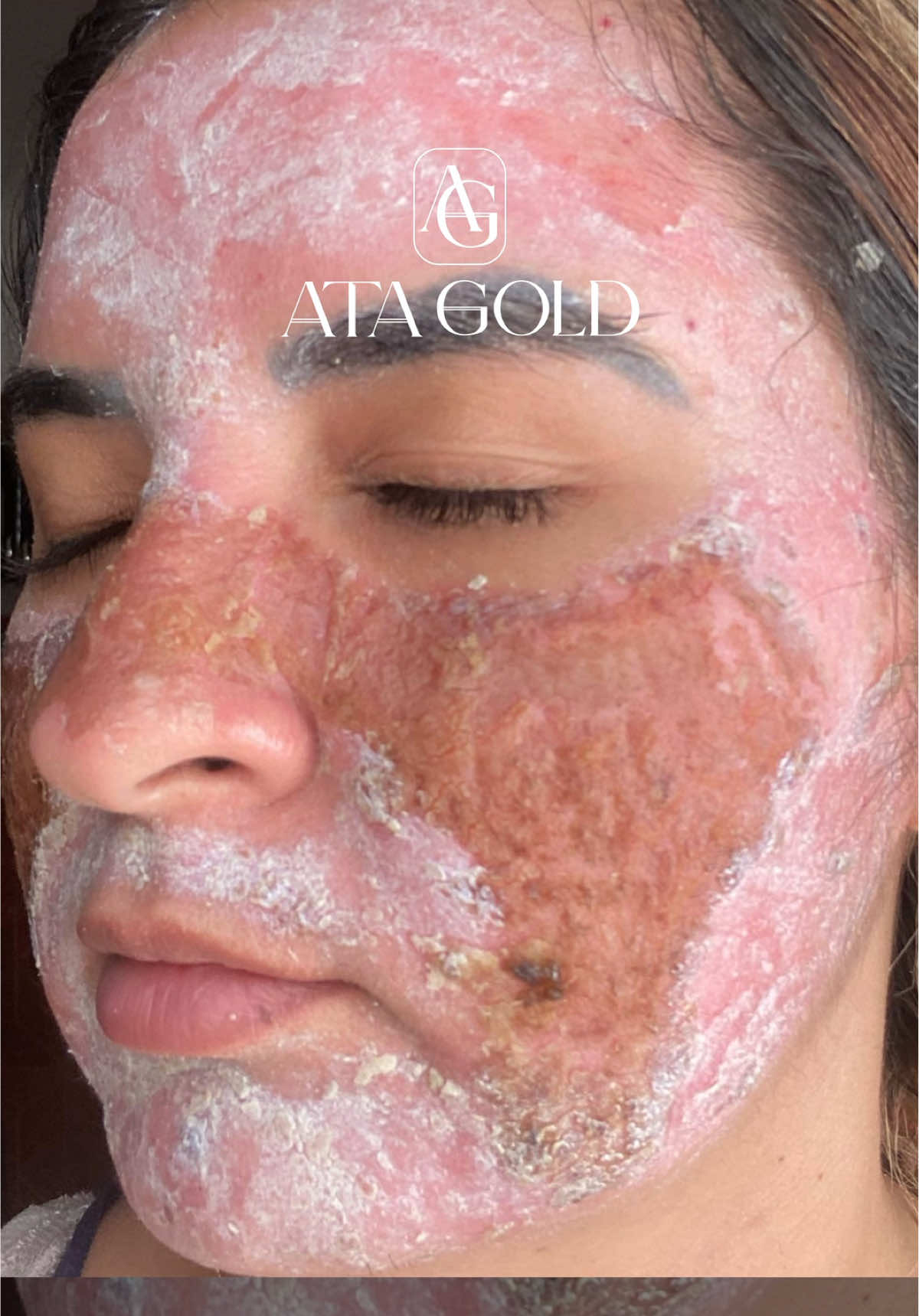 Você teria coragem de passar por isso? ✨ Me conta aqui nos comentários 👇🏼 #peeling #peelingquimico #atagold #skin #peelingprofundo 