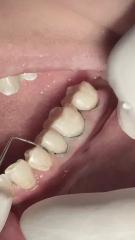 Class V composite for posterior teeth #dentist #dental #dentistry 