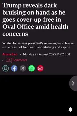 #TRUMP'S VISIBLE BRUISING SPARKS #MEDICAL #CONCERN 