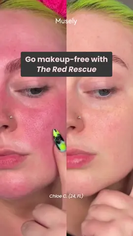 Tired of covering up your redness? 🥵 The Red Rescue can help! Formulated by dermatologists with science-backed ingredients, it soothes flare-ups, flushing, and inflammation for up to 12 hours. Join over 1 million patients achieving real, lasting results with prescription treatments. Get started 100% online at Musely.com