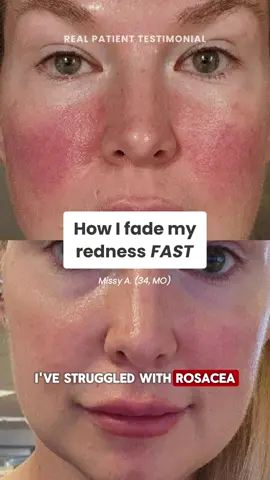 Thanks to The Red Rescue, I haven’t had to use makeup to hide my redness! It faded my rosacea in under 2 hours ✨ Get started with prescription skincare 100% online at Musely.com!