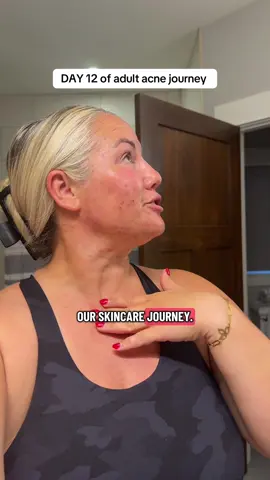Day 12 and let me tell you … the relief my skin is feeling is INSANE 🤍