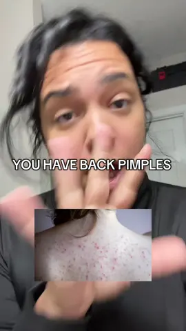 If you have pimples try exfoliating with the African bath sponge to get rid of the dirt and skin cells on your back! #africannetsponge #netsponge #exfoliation #skincare #africannetsponges 