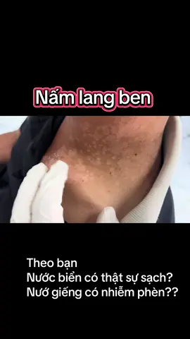 Nấm Lang ben #nấmlangben 
