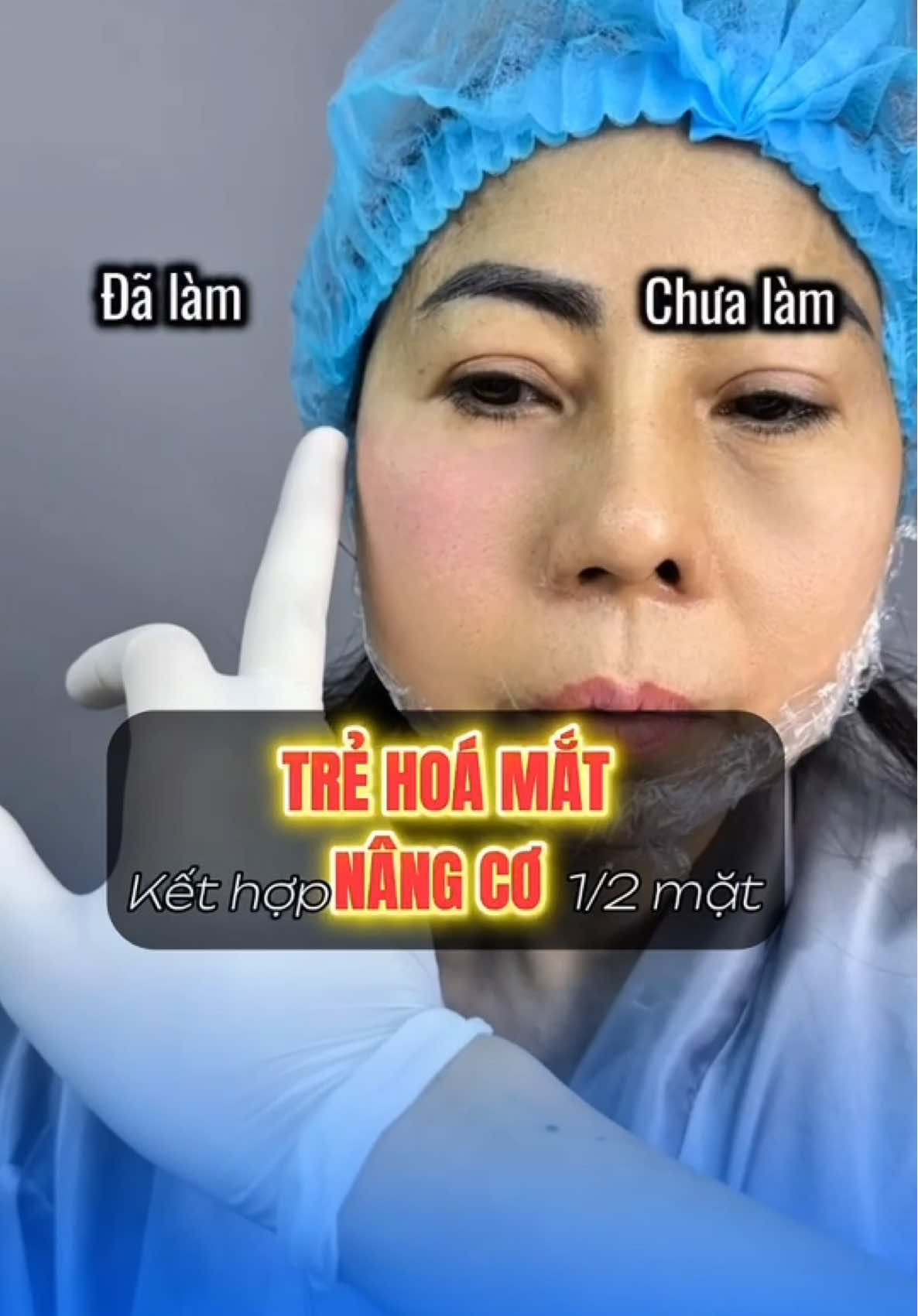 𝐌𝐝𝐜𝐨𝐝𝐞𝐬 𝐦𝐢𝐝𝐟𝐚𝐜𝐞 𝐥𝐢𝐟𝐭. Để hiểu sâu và kĩ thuật nâng cao hiệu quả tối ưu bạn nào qtam IB tại Hà Nội và TPHCM  nhé #xuhuong #lamdep #thammy #learnontiktok #bacsihongtm 
