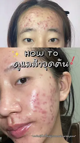 ตอนนี้สิวอุดตันดีขึ้นมาก👀✨ #cerave #ceravesasmoothingcleanser #ดูแลสิว #คลีนเซอร์ #cleanser 