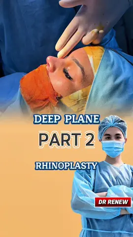 Deep Plane Rhinoplasty DR RENEW CLINIC (Part 2)#rhinoplastyjourney #australia #drrenew #spanishteacher #surgery 