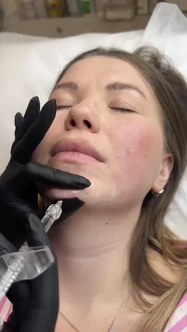 ✨ Chin filler = game changer! A defined chin means a balanced, snatched profile. No surgery. No downtime. Just instant results 💉 Confidence starts with contour 💎 #ChinFiller #FaceContour #injections #AestheticsLondon #GlowUp