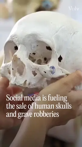 Human skulls and bones are being openly sold on Instagram, with forensic experts warning some show dirt, tissue, and signs of recent grave robbery. Loopholes in the UK’s Human Tissue Act 2004 mean collectors can legally buy and sell remains outside medical use, creating what experts call a new wave of “body snatching.” Reports since 2020 show Facebook and Instagram as hubs for this grim trade.