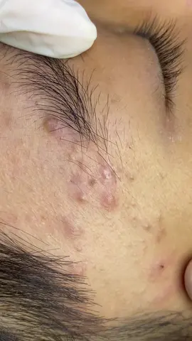 Nhiều nốt còn núp trong lông mày nữa #SắcĐẹpSpa #TrịMụnUyTín #spachuyenmun #pimple #xh 