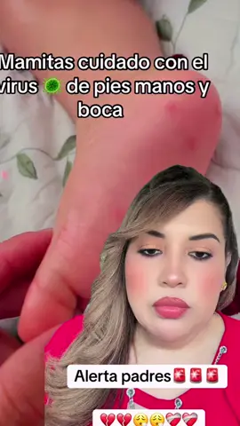 #creatorsearchinsights Si tu hijo presenta estos sintomas esten alertas#virus #piemanoboca #padres #alerta #padresehijos #peligroso⚠️ #peligro #usa🇺🇸 #babies #emergency #noticiaurgente #newsusa 