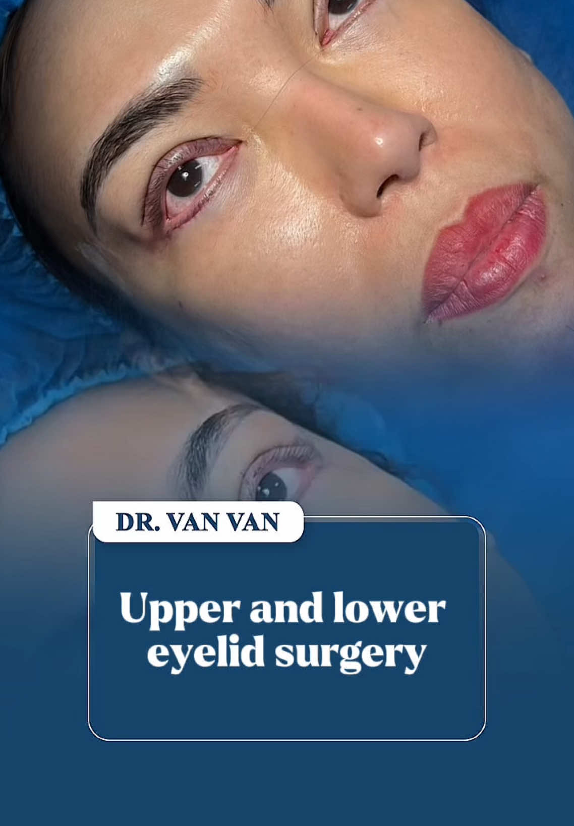 Upper and lower eyelid surgery #surgery #fly #eye #philippines #DrVanVan 