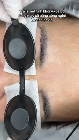 Trả lại nét tinh khôi – xoá bỏ dáng mày cũ bằng công nghệ Laser hiện đại#xoaxamchanmay #tuyennguyenphunxam 