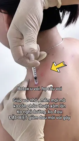 Botox hạ cầu vai, botox u vai #tiemfillerthuduc #tiemfillerquan9 #haiyenbeauty #tiembotoxuvai #tiembotox 