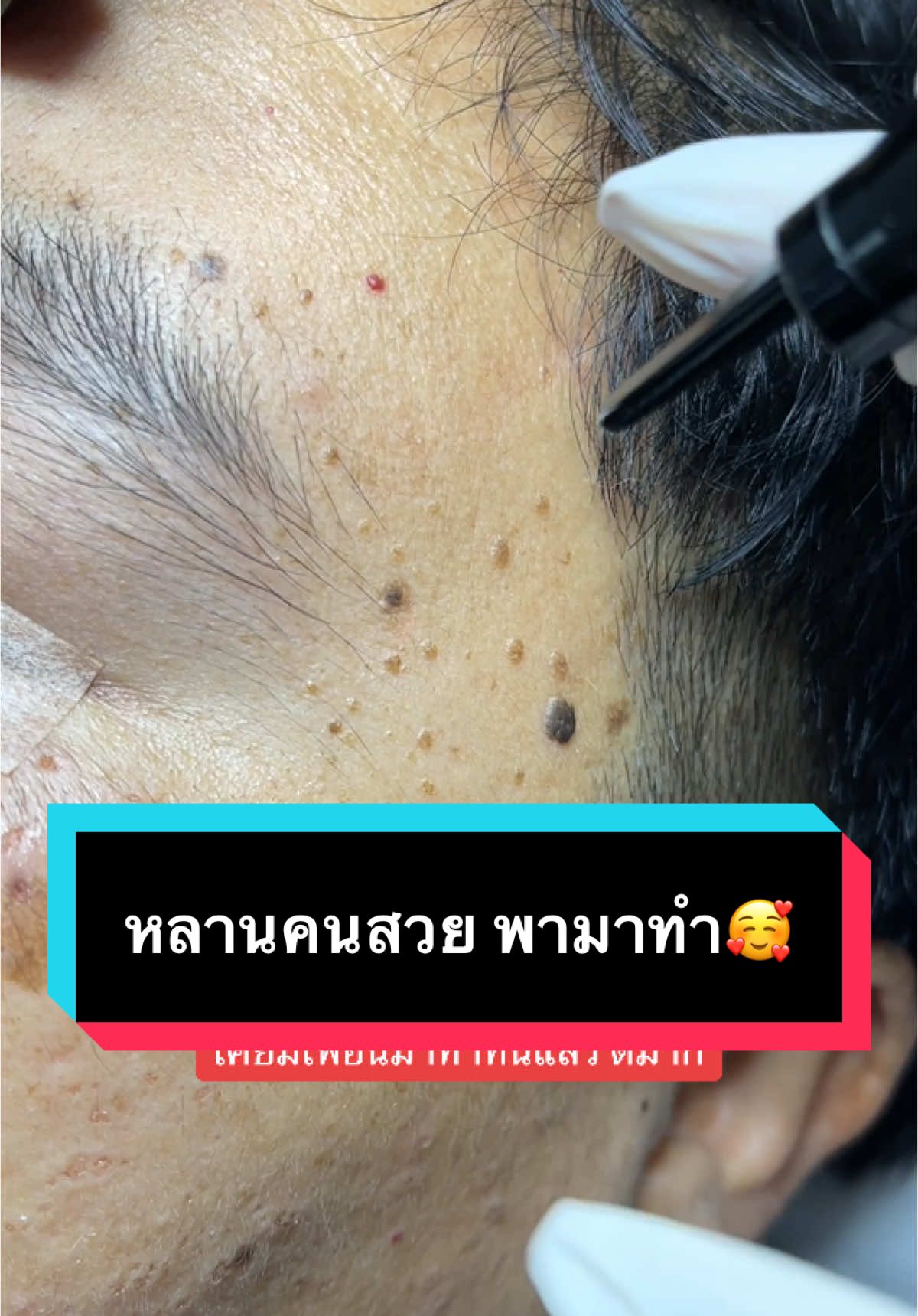 ถ้าทำแล้วดี จะมีแต่คนบอกต่อ🥰 ขอบคุณลูกค้าที่น่ารักทุกท่านมากๆนะคะ ที่ให้ความไว้วางใจ พีแองเจิล คลินิกของเรา #เลเซอร์co2 #เลเซอร์กระเนื้อ #ไม่เป็นแผลเป็น #จี้กระเนื้อ #กระเนื้อ #เลเซอร์ติ่งเนื้อ #จี้กระเนื้อ #จี้ติ่งเนื้อ #ติ่งเนื้อ #เลเซอร์ไฝ #เลเซอร์ต่อมไขมัน #พีแองเจิลคลินิก #