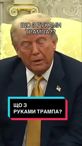 Що це за дивні синці на руках Дональда Трампа?