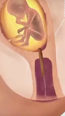 Ever Wondered How Abortion Works?#AbortionFacts #WomensHealth #PregnancyCare #AbortionAwareness #HealthEducation #MedicalFacts #ReproductiveHealth #KnowYourOptions 