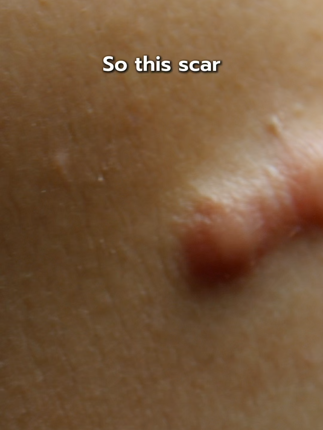 Scars don’t get free rent on my skin. 🤬 #BeBetterSkin #ScarCare #GlowUp  #SkincareThatWorks #TikTokMadeMeTryIt  #scar #keloid #pigmentation #healingjourney #woundcare