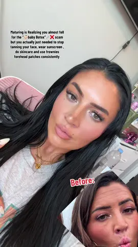 #frownies #botoxalternative #naturalglowup #frowniesfacialpatches #frowniesresults 