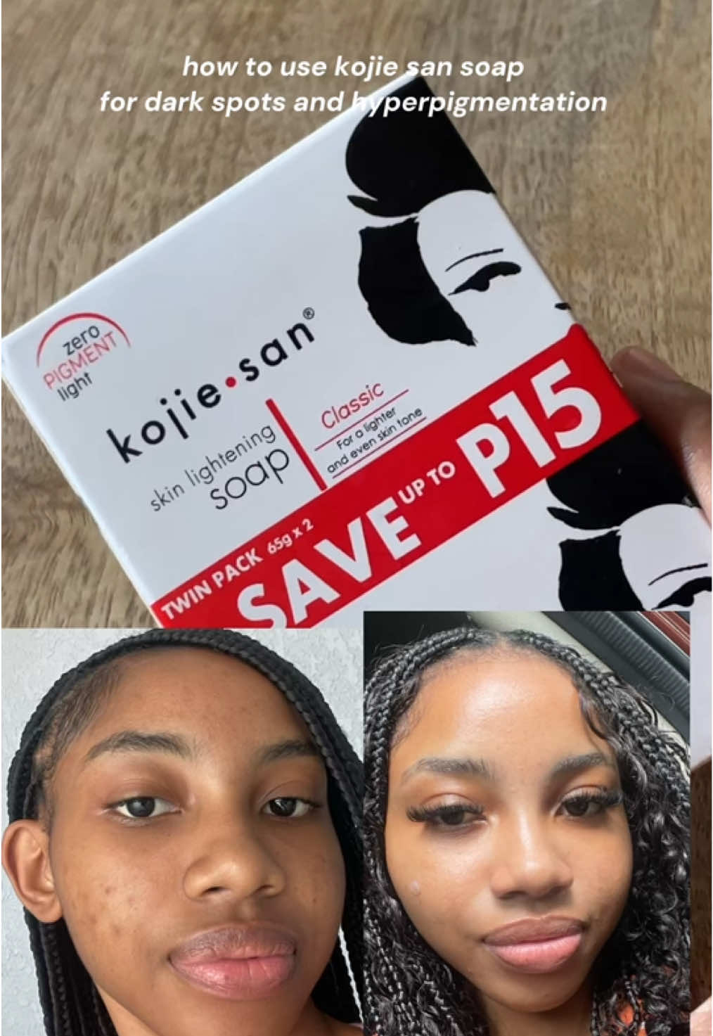 Kojie San soap for dark spots and hyperpigmentation. Link in my Amazon storefront. I got hyperpigmentation and darkspots after having getting acne breakouts in high school. It didn’t lighten my skin. I’ve always been brown since birth  #fyp #skincare #korean ##CapCut 